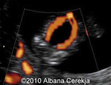 Trisomy13_Albana_15