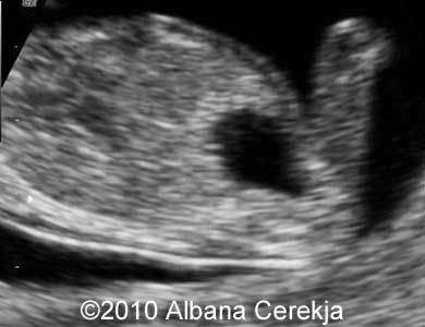 Trisomy13_Albana_16