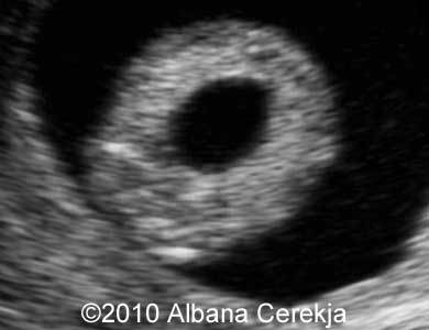 Trisomy13_Albana_17