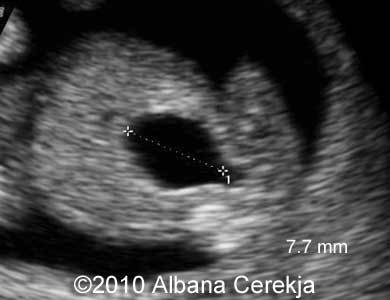 Trisomy13_Albana_18