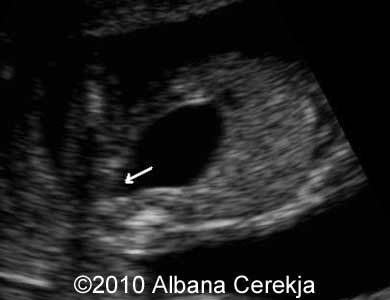 Trisomy13_Albana_19