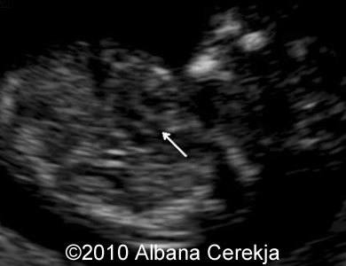 Trisomy13_Albana_2