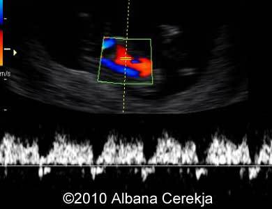 Trisomy13_Albana_21