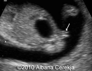 Trisomy13_Albana_5