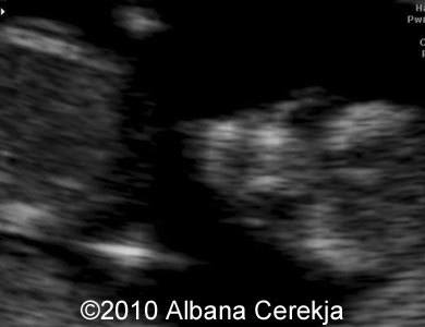 Trisomy13_Albana_6