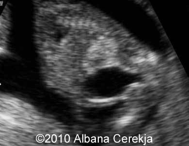 Trisomy13_Albana_7
