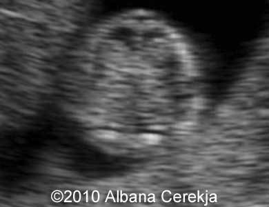 Trisomy13_Albana_8