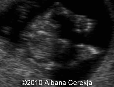 Trisomy13_Albana_9