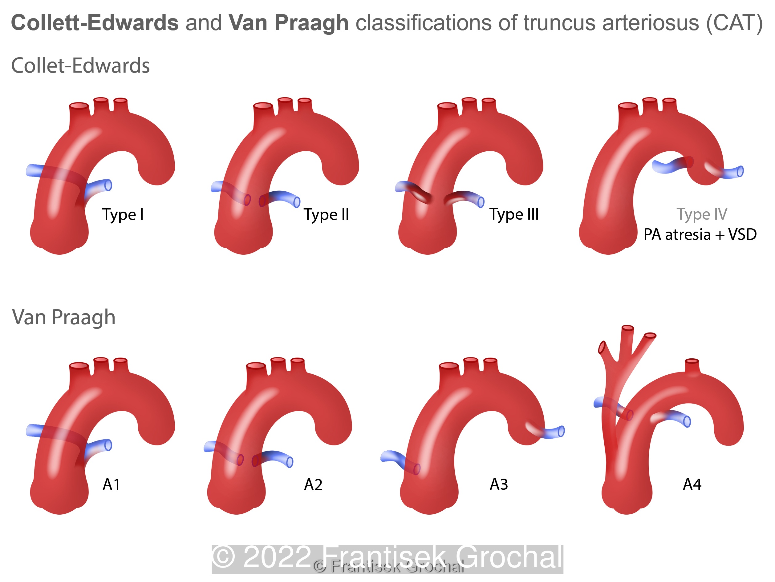 Classification systems of Common Arterial Trunk