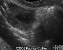 Ectopic pregnancies, five different types image