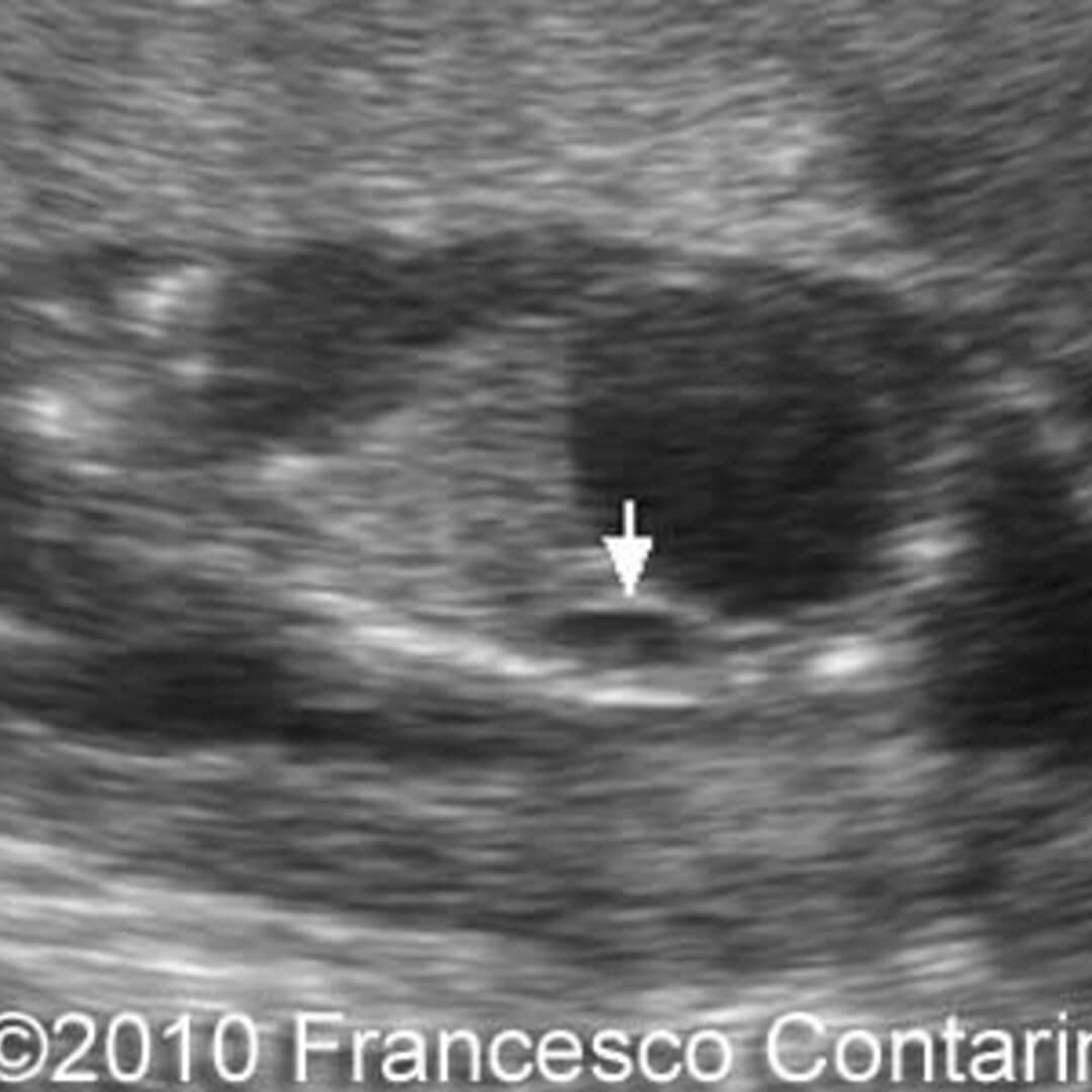 📃 Posterior urethral valves