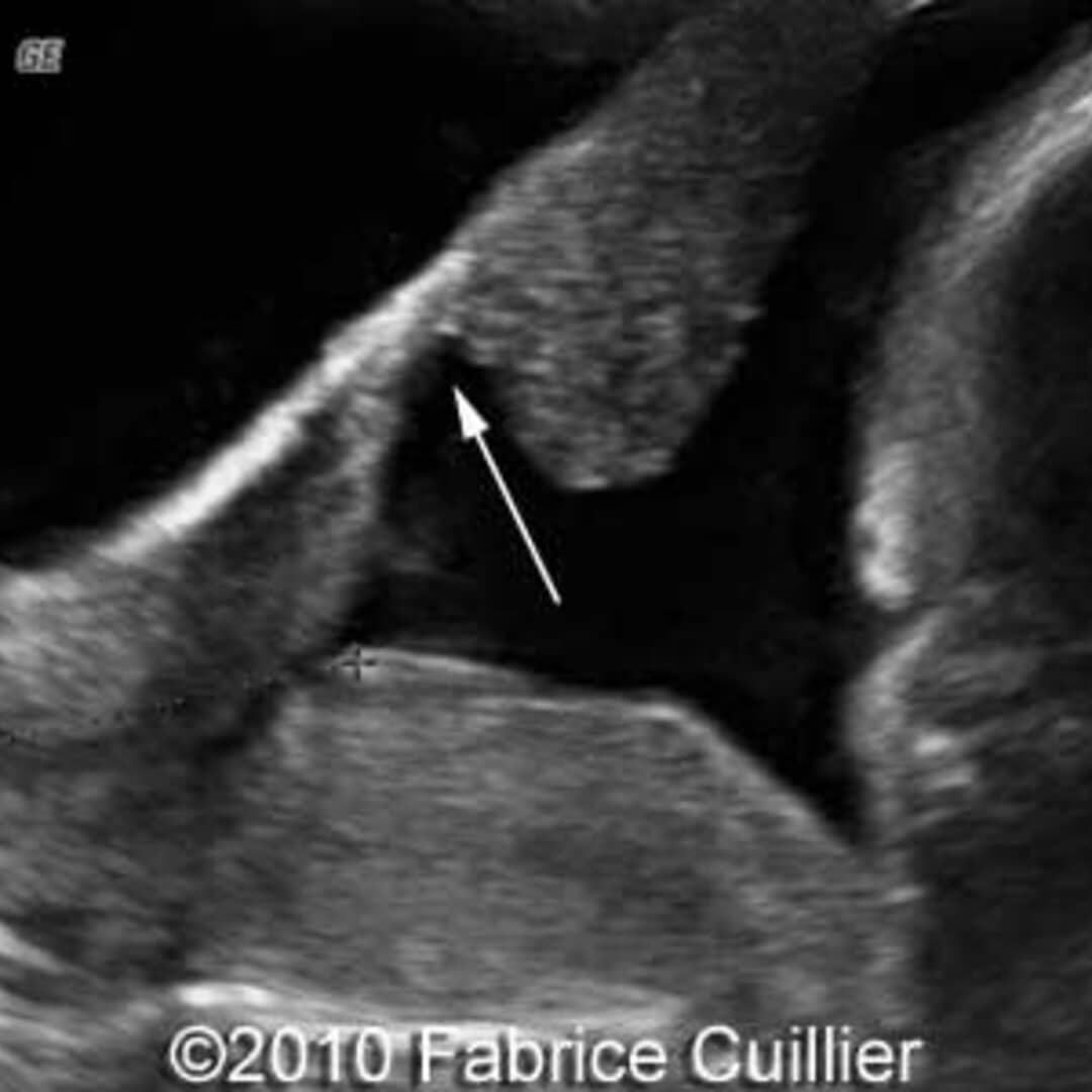 📃 Uterine scar dehiscence