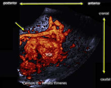 Vein of Galen aneurysm, 3D rendering image