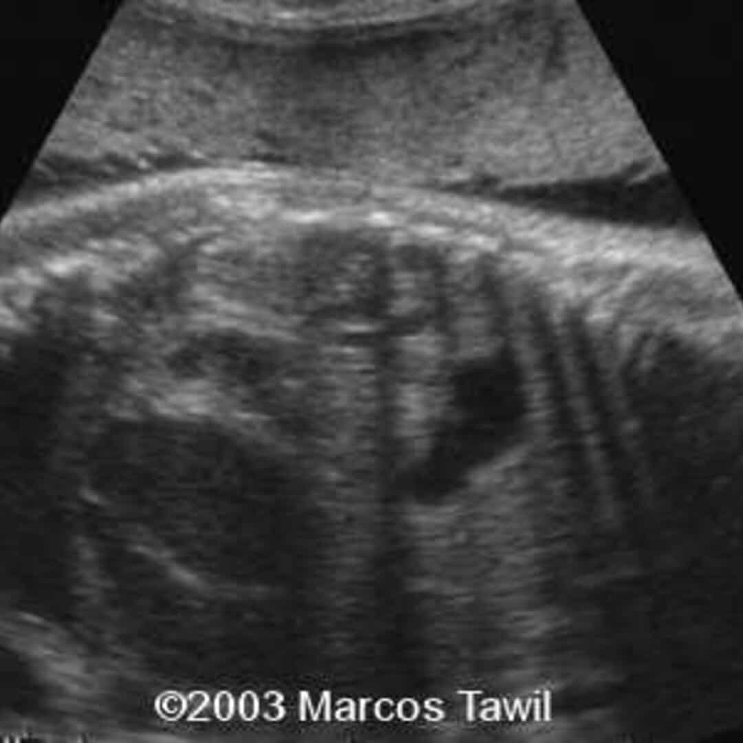 📃 Volvulus on a meconial plug syndrome