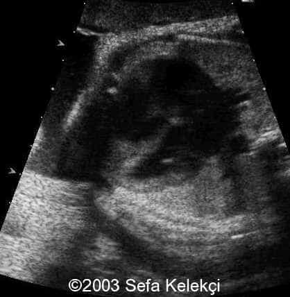 📃 Ventricular septal defect, trabecular portion