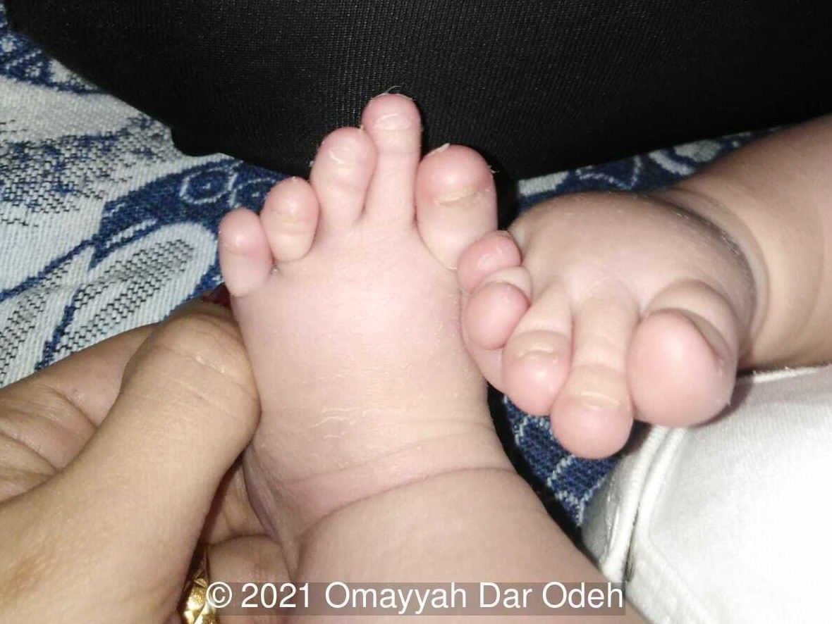 Dysplastic fingernails
